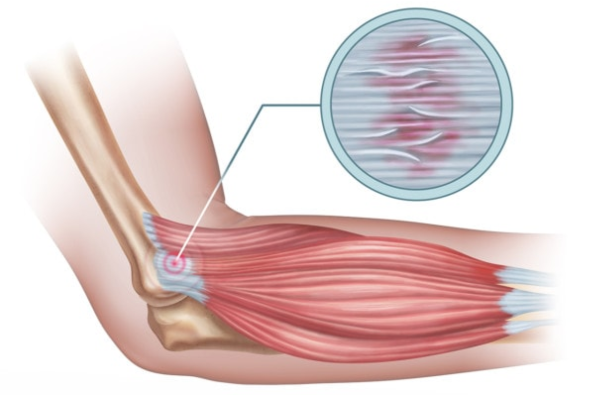 Tennis Elbow Cure